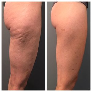 Profound Skin Tightening And Cellulite Reduction 19 Profound Skin Tightening and Cellulite Reduction