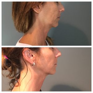 Profound Skin Tightening And Cellulite Reduction 18 Profound Skin Tightening