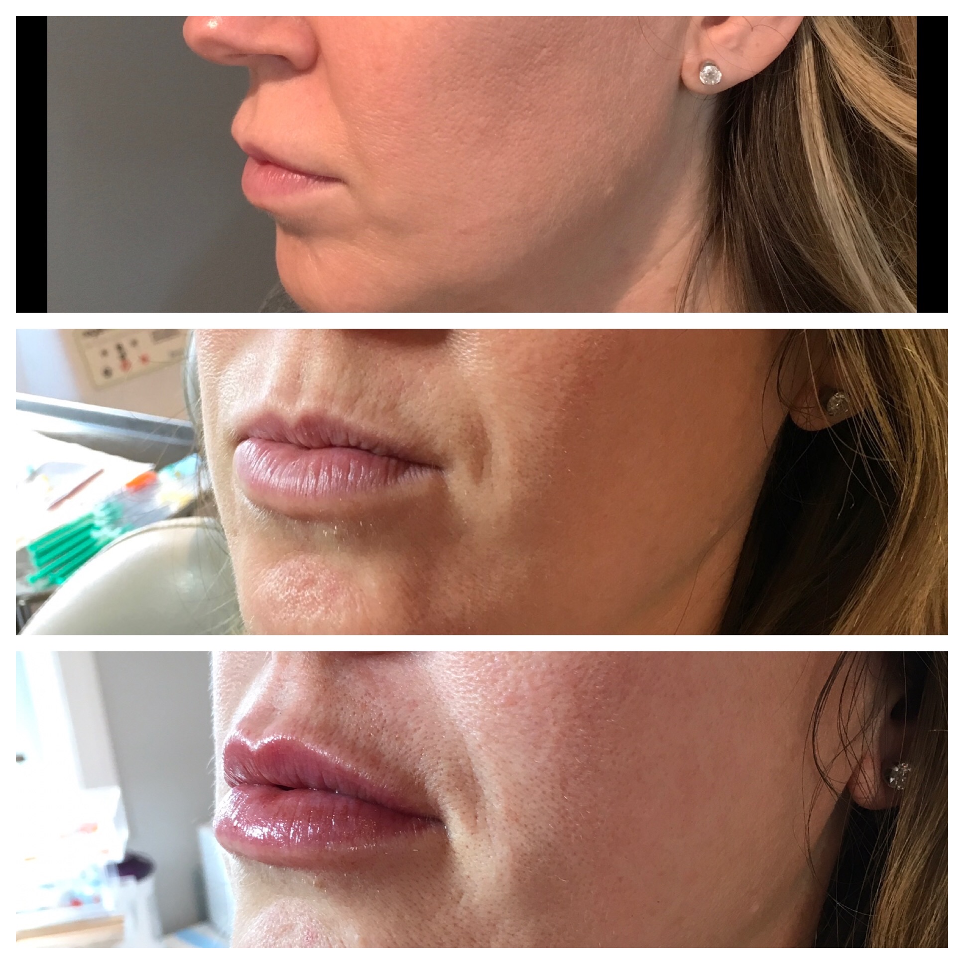 The Importance Of The Injector With Lip Filler Treatments 1 Profound Skin Tightening delle chiaie medicine nine