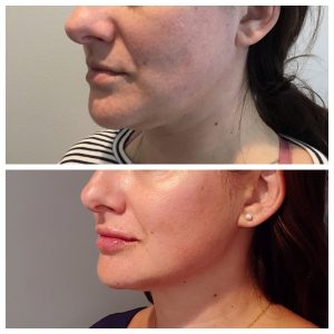 Profound Skin Tightening And Cellulite Reduction 20 Profound Skin Tightening