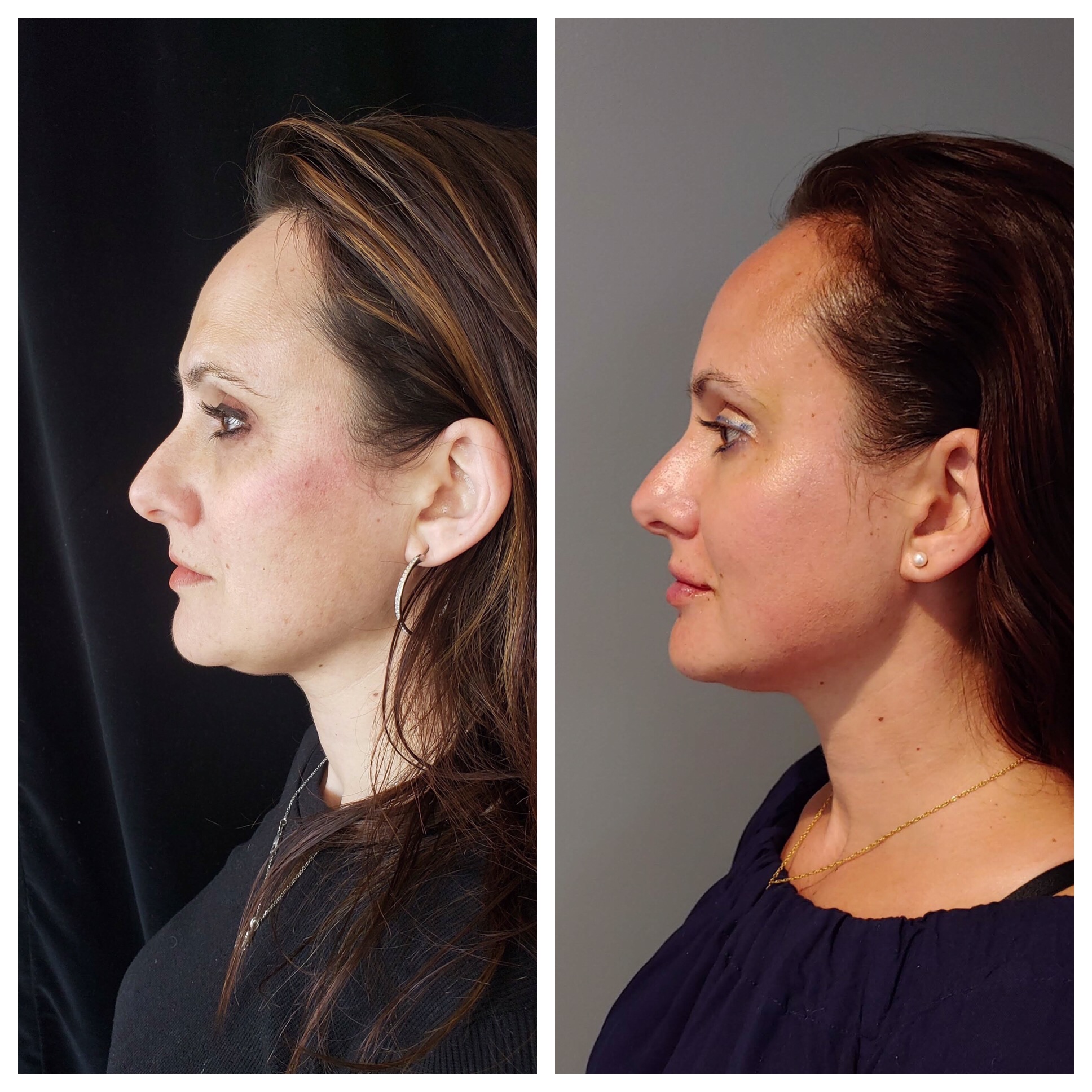 Hydrafacial Is More Than Just A Facial! 1 Profound Skin Tightening delle chiaie medicine