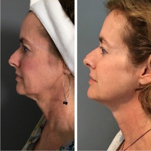 Profound DCCM Hampton NH Before and after 12