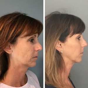 Profound DCCM Hampton NH Before and after 14