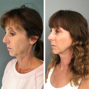 Profound DCCM Hampton NH Before and after 15