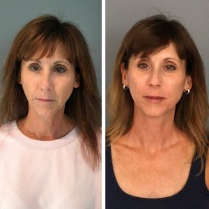 Profound DCCM Hampton NH Before and after 16