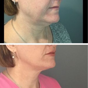 Profound Skin Tightening And Cellulite Reduction 17 Profound DCCM Hampton NH Before and after 2