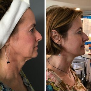 Profound DCCM Hampton NH Before and after 3