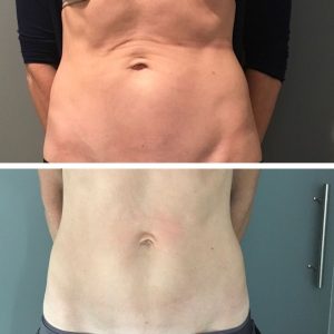 Profound DCCM Hampton NH Before and after