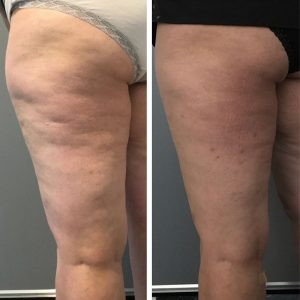 Profound DCCM Hampton NH Before and after 5