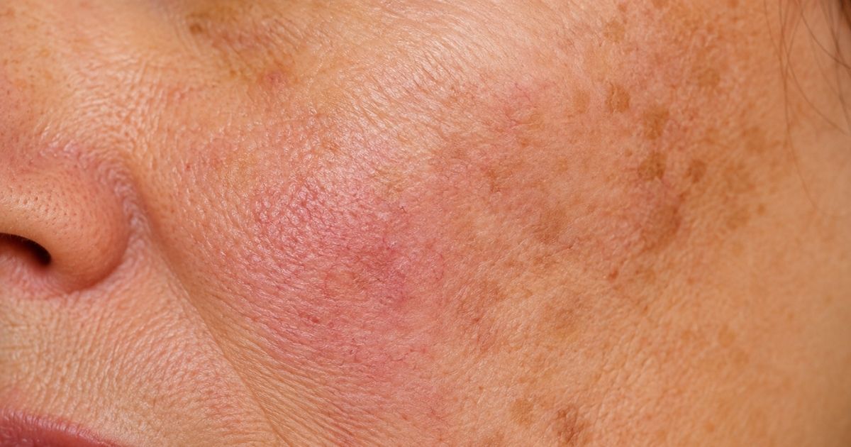 Close-up of skin showing sun spots, redness, and rough texture